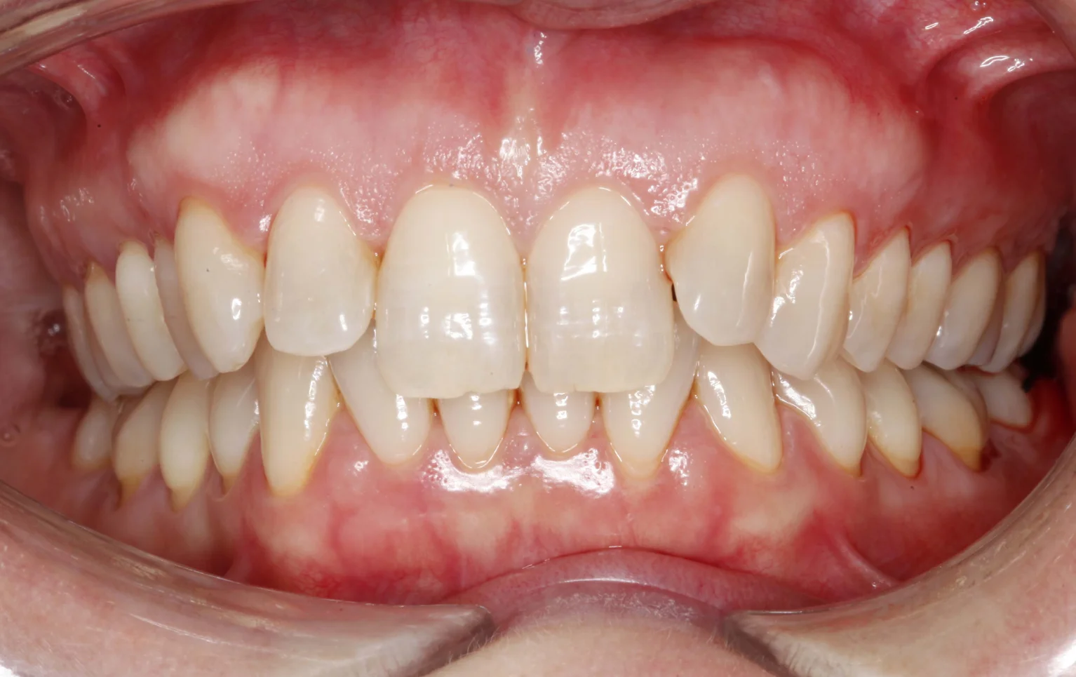 Paciente con ortodoncia invisible en Clínica Dental Segura de Lago en Xàtiva