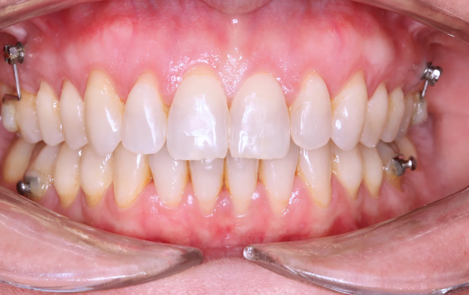 Paciente con ortodoncia invisible en Clínica Dental Segura de Lago en Xàtiva